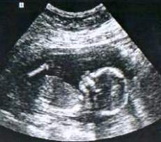 Ultrasonografia in sarcina ecografia prenatala